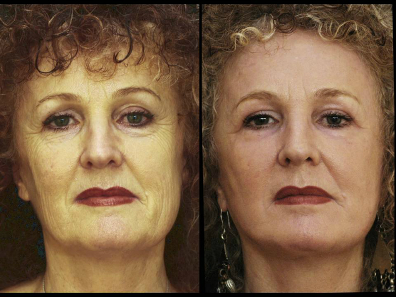 Laser Skin Resurfacing Surgery