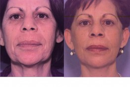 Laser Skin Resurfacing Surgery