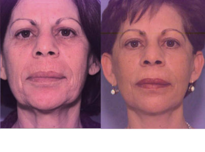 Laser Skin Resurfacing Surgery