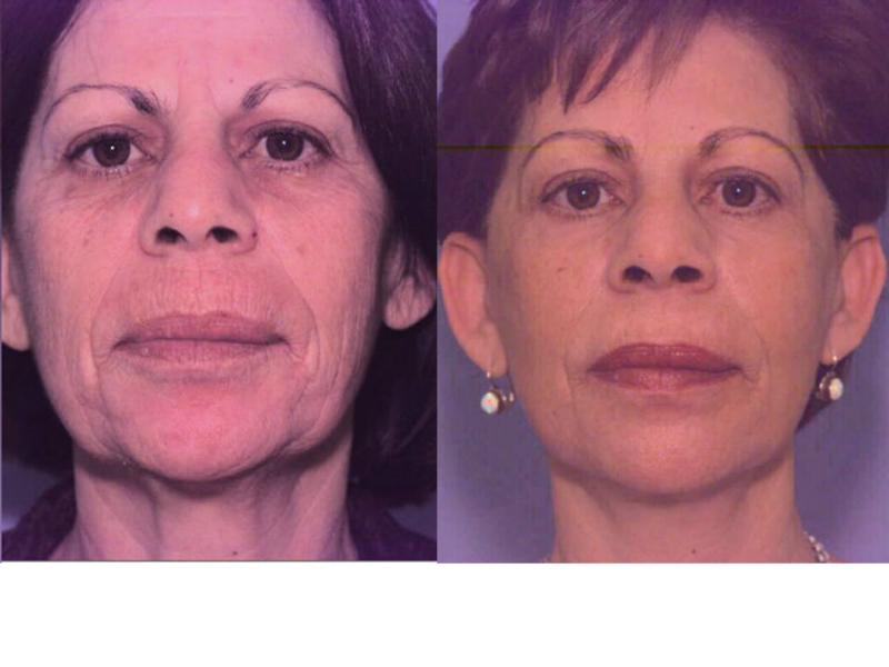 Laser Skin Resurfacing Surgery