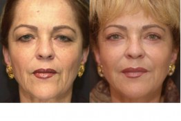 Laser Skin Resurfacing Surgery