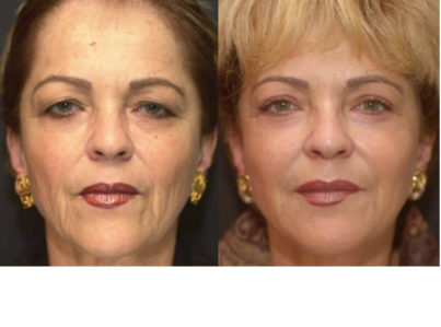 Laser Skin Resurfacing Surgery