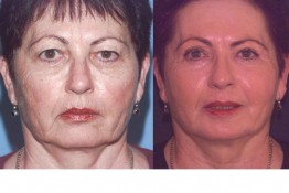 Laser Skin Resurfacing Surgery