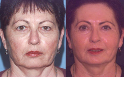 Laser Skin Resurfacing Surgery