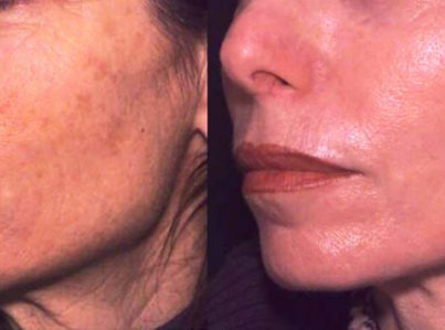 Laser Skin Resurfacing Surgery