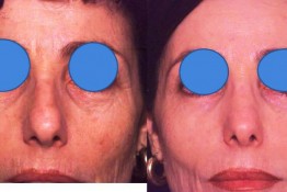 Laser Skin Resurfacing Surgery