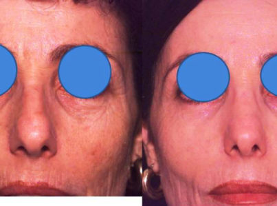 Laser Skin Resurfacing Surgery