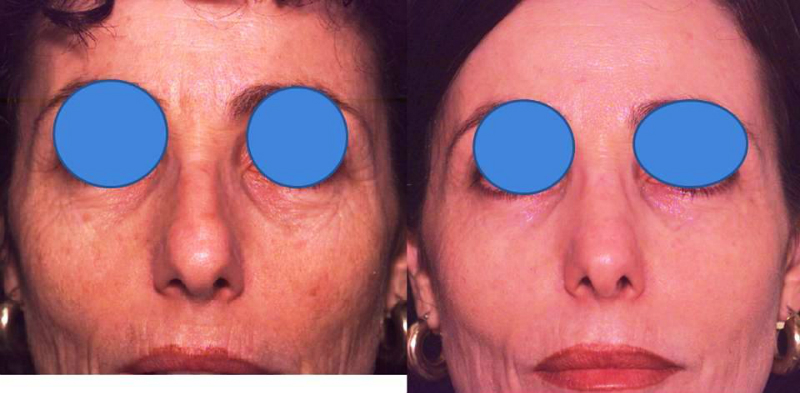 Laser Skin Resurfacing Surgery