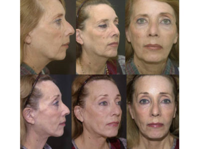 Laser Skin Resurfacing Surgery