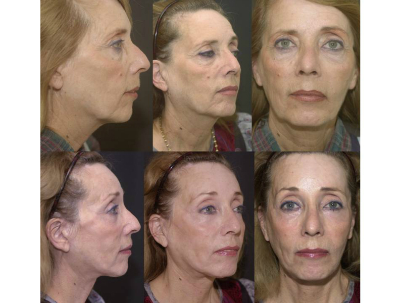 Laser Skin Resurfacing Surgery