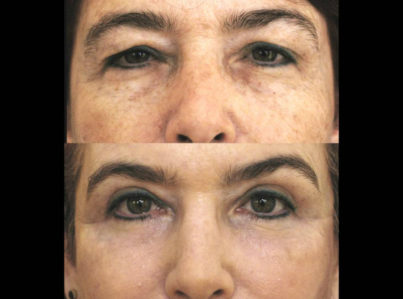 Laser Skin Resurfacing Surgery