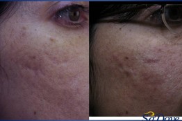 Acne Scar Surgery