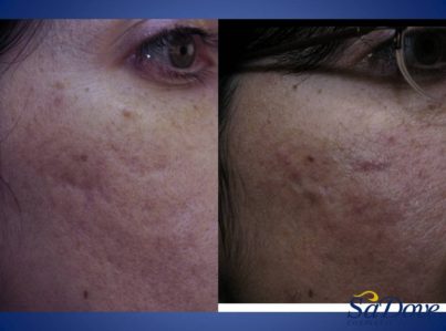 Acne Scar Surgery