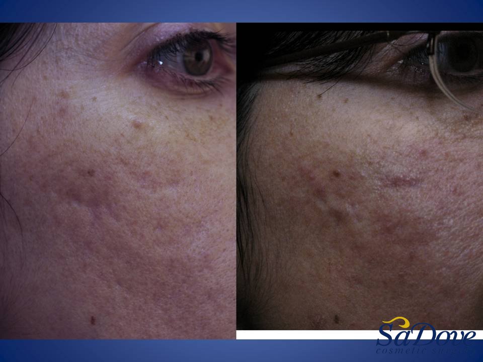 Acne Scar Surgery