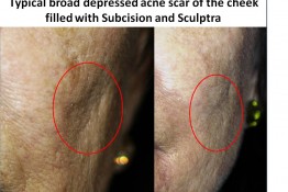 Acne Scar Surgery