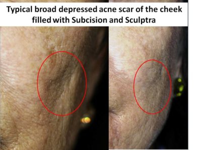 Acne Scar Surgery