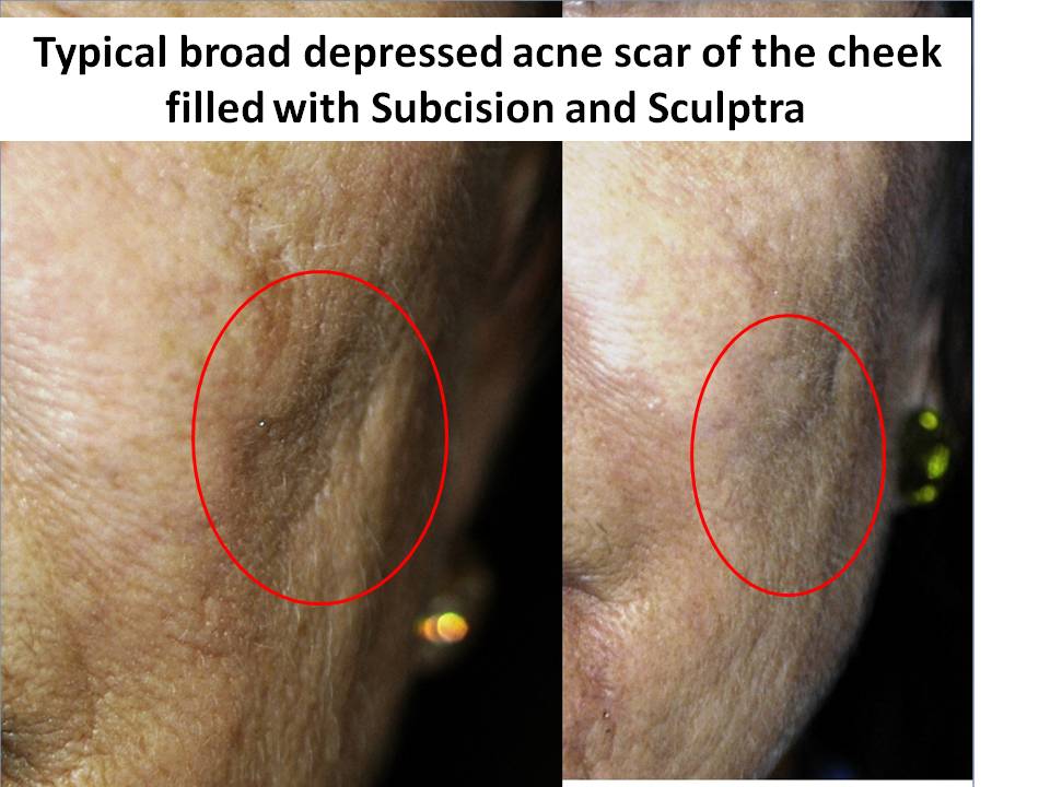 Acne Scar Surgery