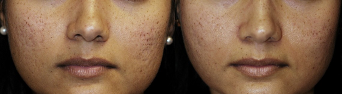 Acne Scar Surgery