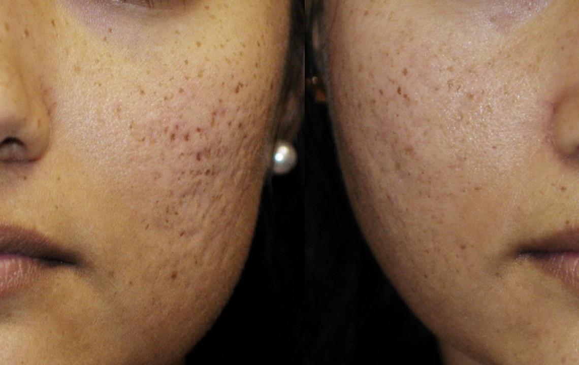 Acne Scar Surgery