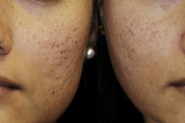 Acne Scar Surgery