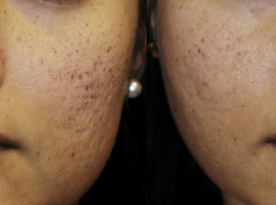 Acne Scar Surgery