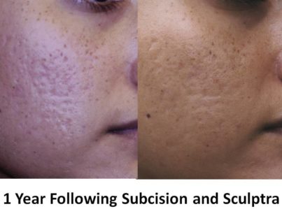 acne-scar28