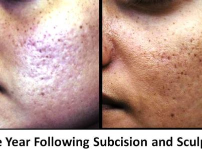 Acne Scar Surgery