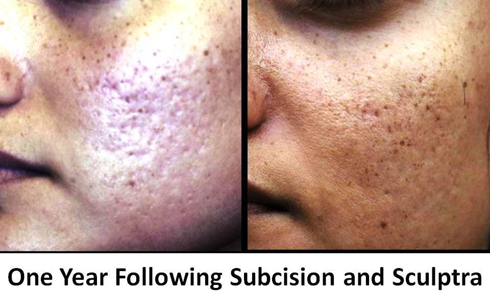 Acne Scar Surgery