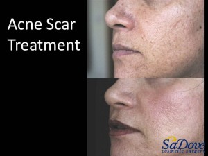 Acne Scar Surgery