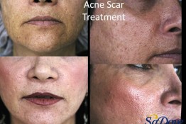 Acne Scar Surgery