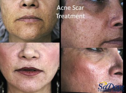 Acne Scar Surgery