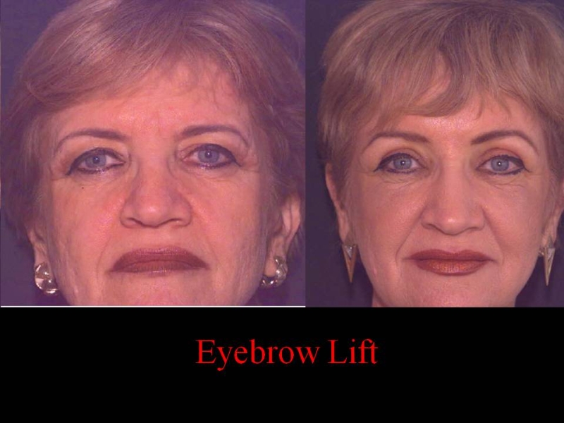 brow-lift13