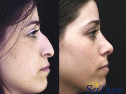 nose-surgery12