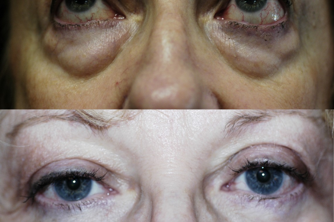 Lower Eyelid Surgery