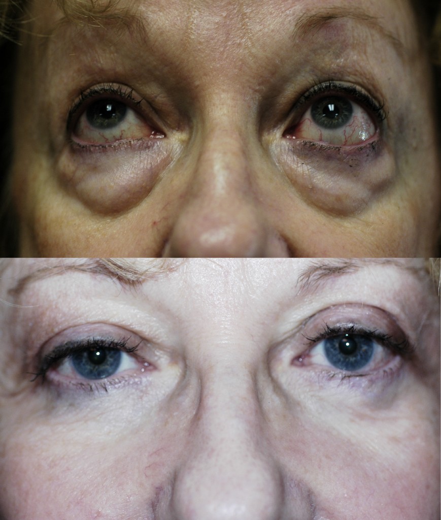 Lower eyelid bags gainesville Sadove Cosmetic Surgery
