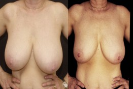 Breast Reduction with Liposuction Only Surgery