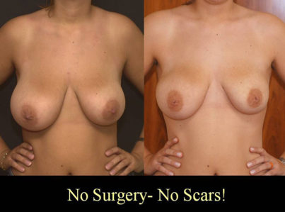 Breast Reduction with Liposuction Only Surgery