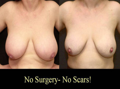 Breast Reduction with Liposuction Only Surgery