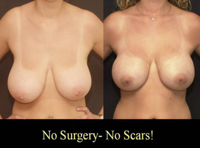 Breast Reduction with Liposuction Only Surgery