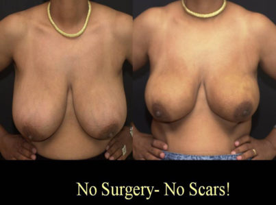 Breast Reduction with Liposuction Only Surgery