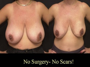 Breast Reduction with Liposuction Only Surgery