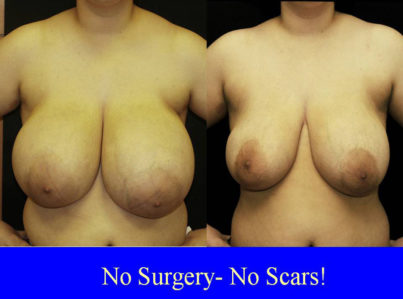 Breast Reduction with Liposuction Only Surgery