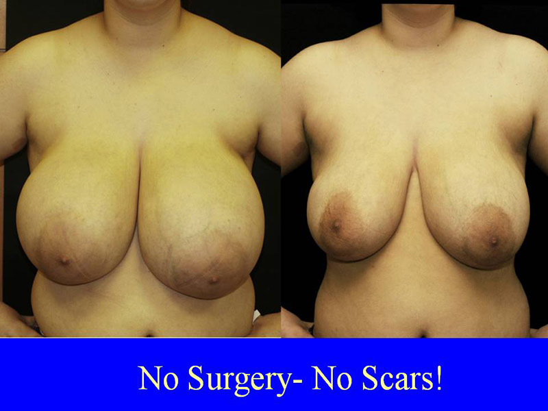Breast Reduction with Liposuction Only Surgery
