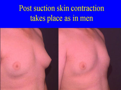 Breast Reduction with Liposuction Only Surgery