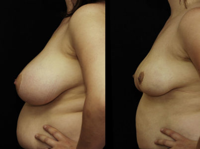 Breast Reduction with Liposuction Only Surgery