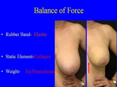 Breast Reduction with Liposuction Only Surgery