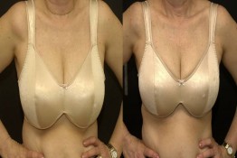 Breast Reduction with Liposuction Only Surgery