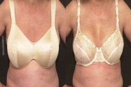 Breast Reduction with Liposuction Only Surgery