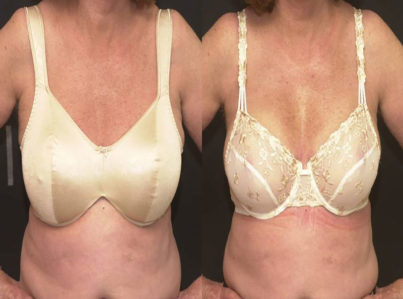 Breast Reduction with Liposuction Only Surgery