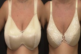 Breast Reduction with Liposuction Only Surgery